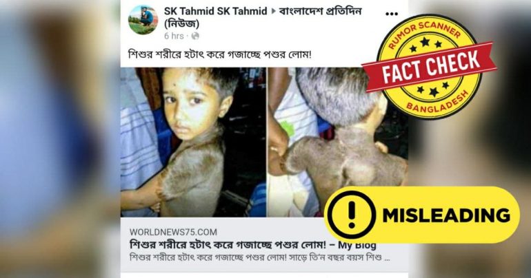 শিশুর শরীরে হঠাৎ করে পশুর লোম গজানোর সংবাদটি পুরোনো ও বিভ্রান্তিকর